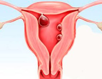 polipo mioma endometriose